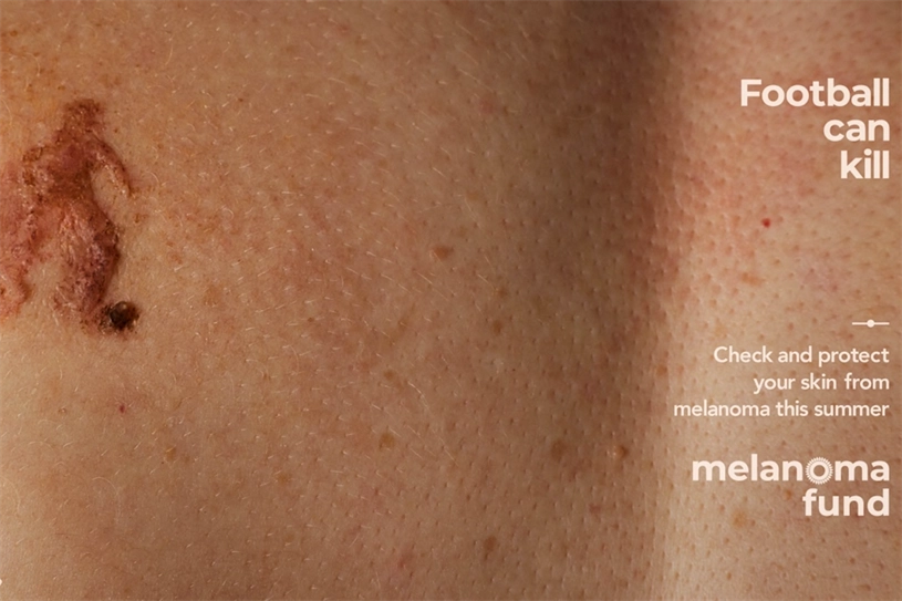 Close-up of a dark, irregular skin lesion beside the words “Football can kill” from the Melanoma Fund campaign